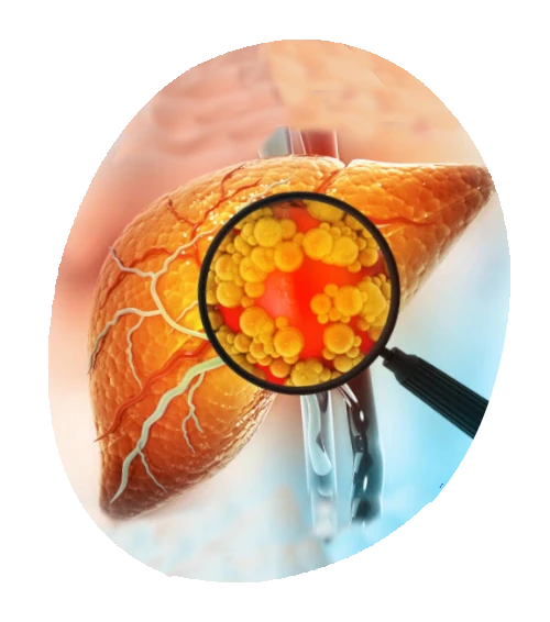 cirrosis_hepática_CEHYD_1