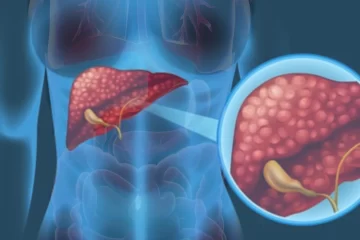 cirrosis_hepática_CEHYD_imagen_destacada